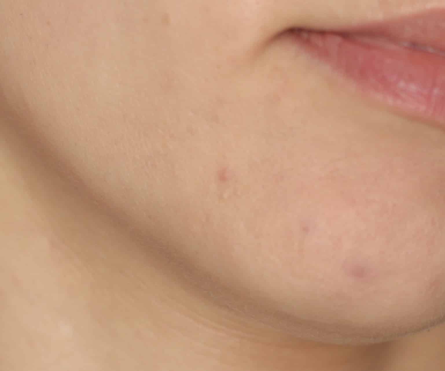 How To Treat Hormonal Acne